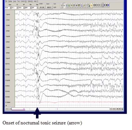 graph of EEG